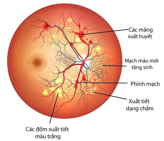 BỆNH VÕNG MẠC ĐÁI THÁO ĐƯỜNG